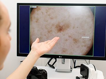 MoleMap scan results on screen